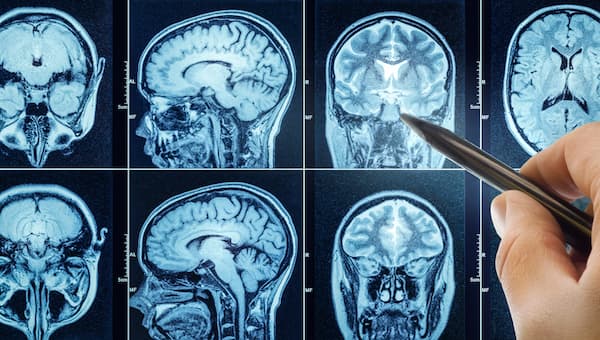 A series of brain scans taken by an MRI machine.